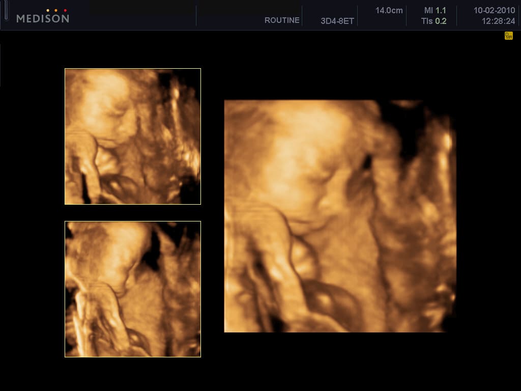 4D echo van een baby tijdens de zwangerschap